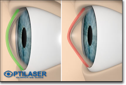 Clinica de ojos Optilaser - Queratocono